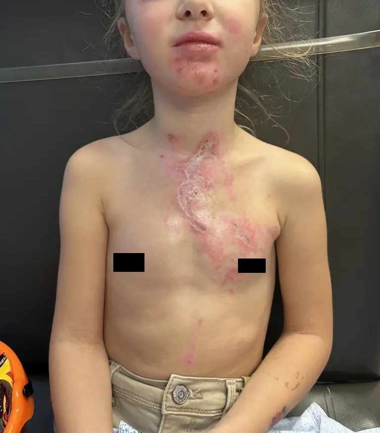 Niña sufrió quemaduras y terminó en coma tras reto viral en TikTok