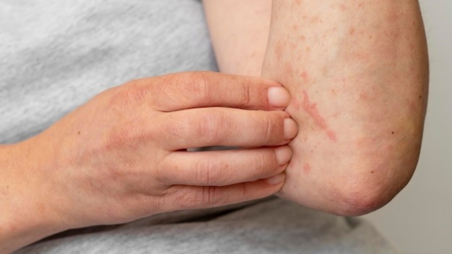 La dermatitis atópica afecta la calidad de vida