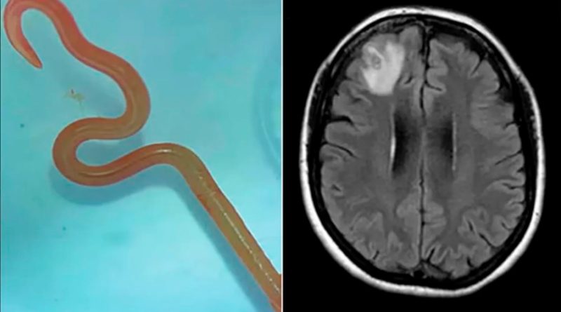 Lombriz viva fue hallada en el cerebro de una mujer australiana