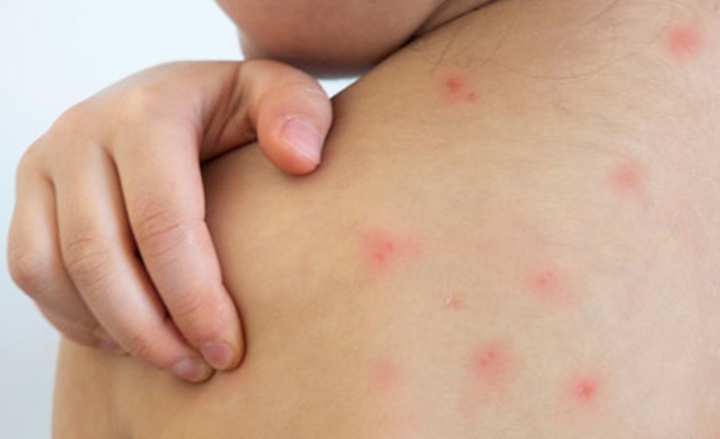 OMS: amenaza del sarampión crece ante falta de vacunación