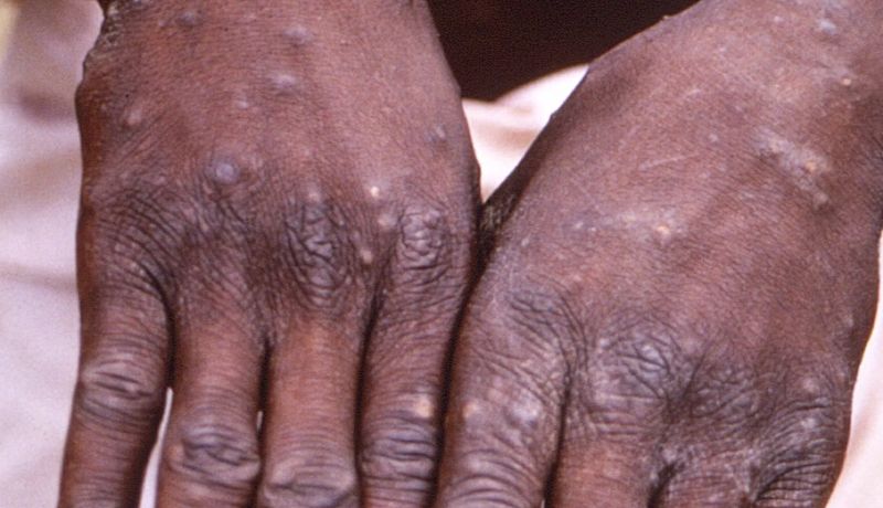 Viruela símica en el Congo: la nueva preocupación de la OMS