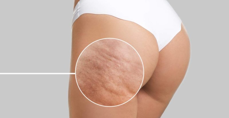 Adiós a la celulitis en poco tiempo y sin dolor con Onda Plus