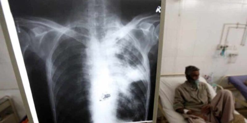Confirman brote de tuberculosis Sucre