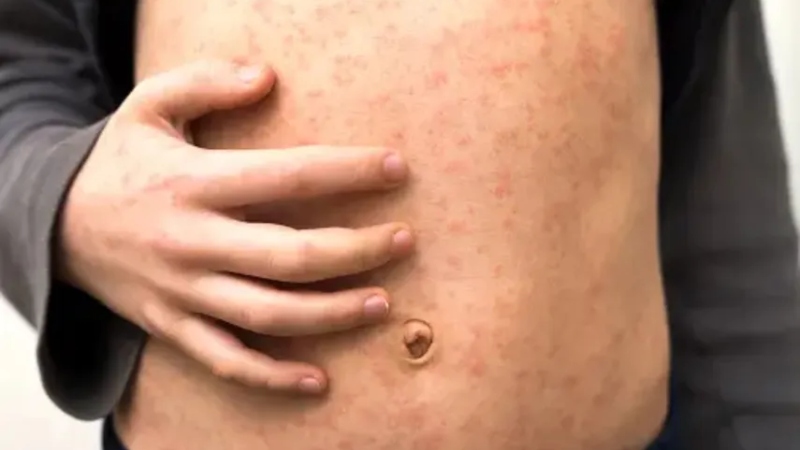 Alerta en EEUU por aumento en casos de sarampión