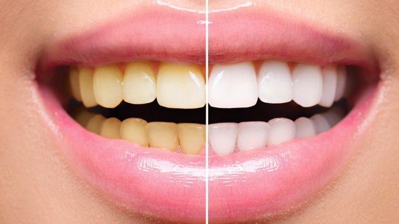 Así podrás evitar el color amarillento en los dientes