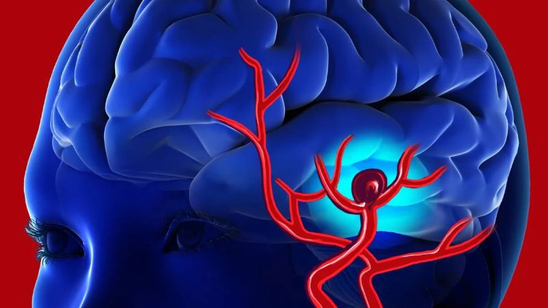 Qué es un aneurisma cerebral y por qué se produce