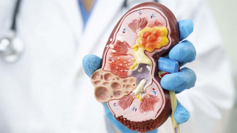 Los 8 alimentos que provocan la aparición de cálculos renales